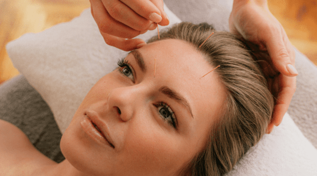 Acupuntura facial | Treatwell