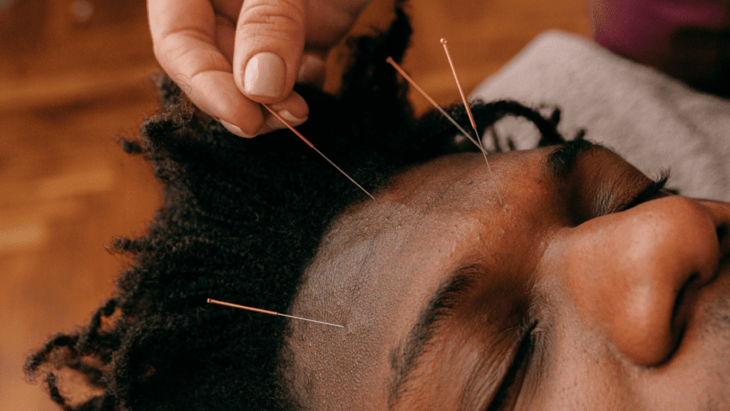 Acupuntura facial_1 | Treatwell